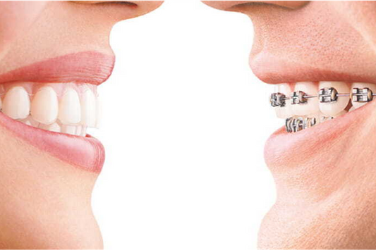 An image showing teeth straightening options: Aligners and Braces.