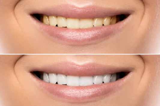 A girl showing her teeth before and after teeth whitening.