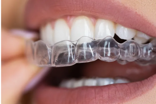  A girl applying a dental night guard for teeth grinding.