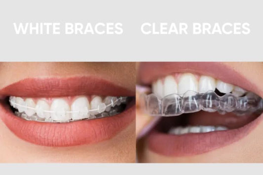 White Braces vs Clear Braces: What’s the Difference?