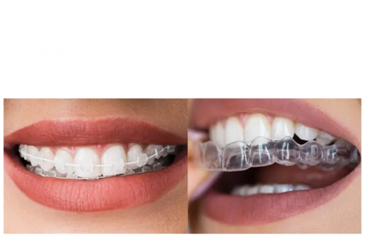 White braces vs clear braces