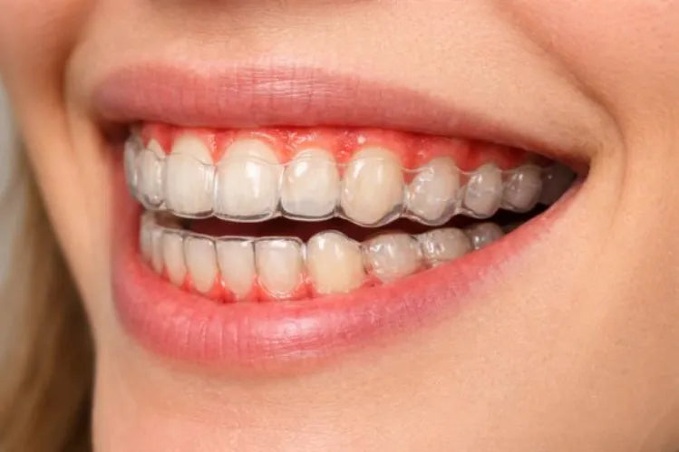  A close-up of a person's smile wearing clear dental aligners, showing visible redness and inflammation 