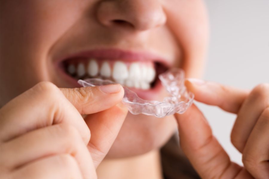 Are Teeth Aligners Right For You?