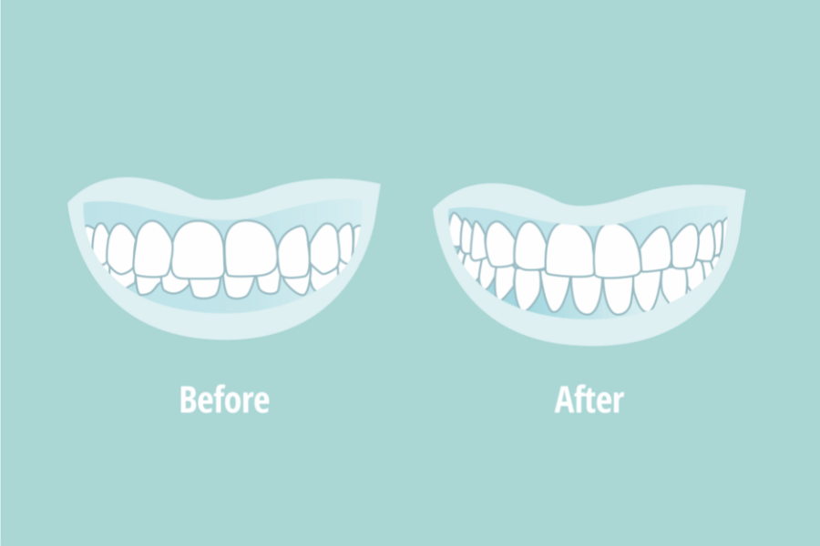 Fix an overbite