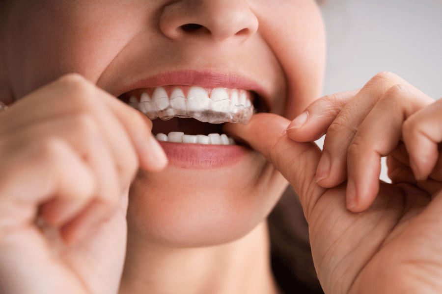 The Convenience and Comfort of Invisible Aligners