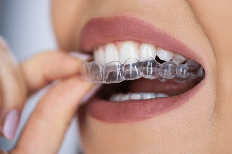 Clear Aligners Before and After