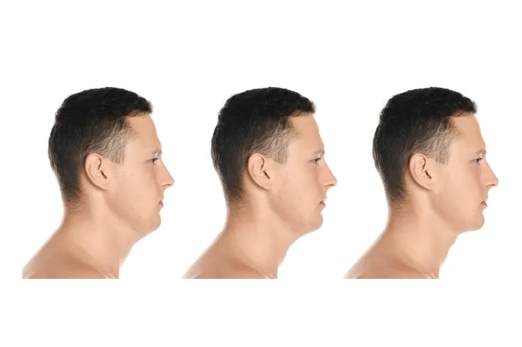 A person showing stages of chin recession