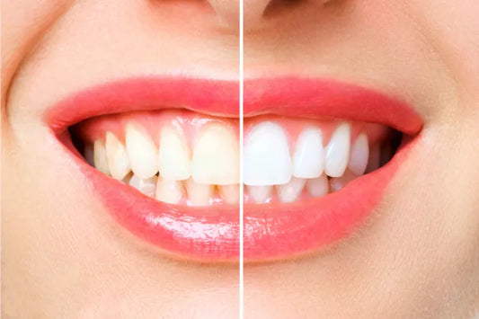 A close-up of before and after teeth whitening 