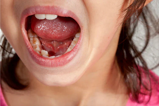 Girl showing her mouth with misaligned bottom teeth