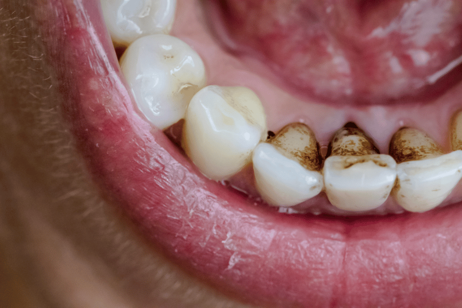 tooth discoloration