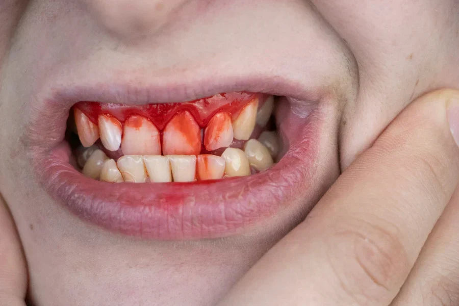 Severe bleeding of the gums