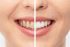 Teeth Whitening: How It Works and What to Expect