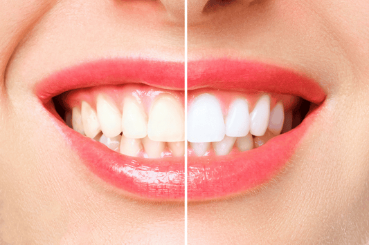 Overcoming Stains: How Teeth Whitening Restores a Youthful Smile