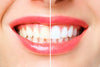Teeth Polishing vs. Teeth Whitening: What's the Difference? Get the Facts Here!