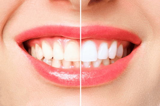 Overcoming Stains: How Teeth Whitening Restores a Youthful Smile