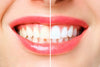 Why is Teeth Whitening So Popular?