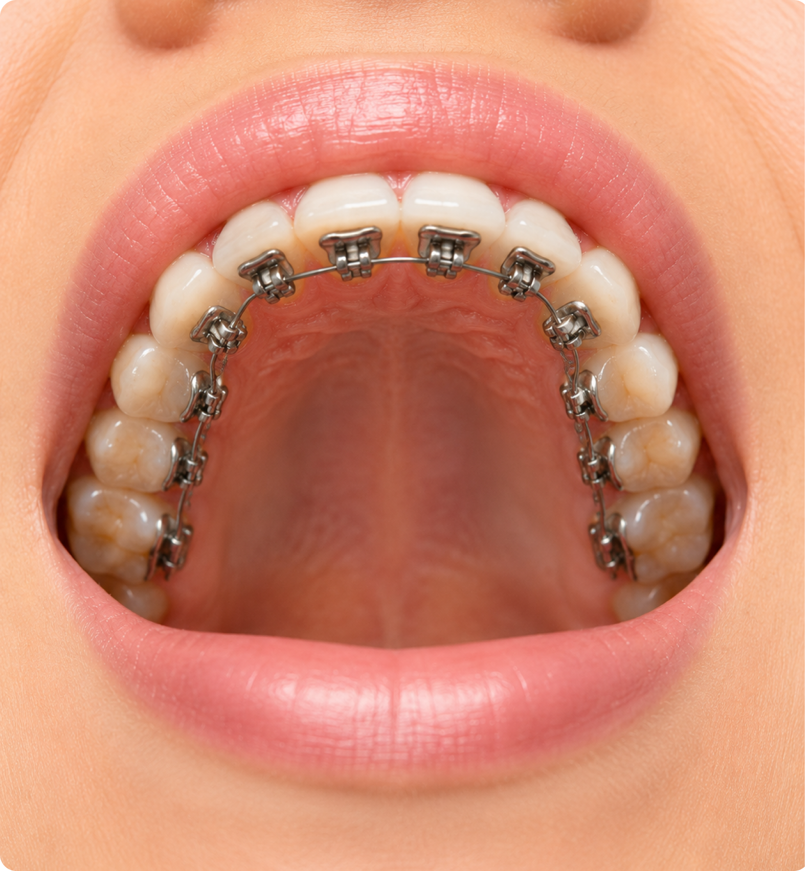 Lingual Braces